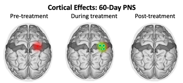 Cortical Effects 60-Day PNS