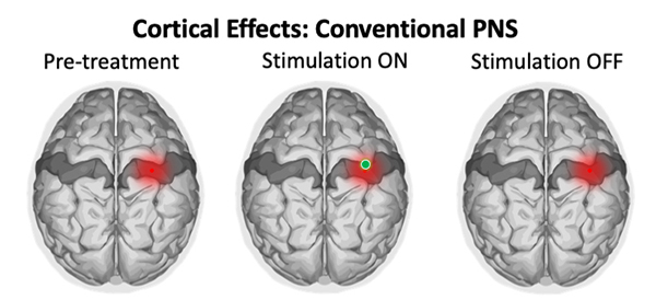 Cortical Effects Conventional PNS